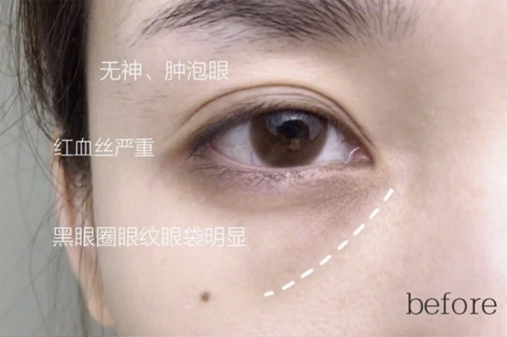 黑科技眼膜贴，眼周肌肤问题靠它啦